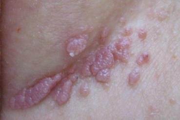hpv vírus tedavisi erkek giardiasis atópiás dermatitis