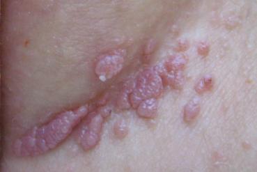 hpv belirtisi nedir